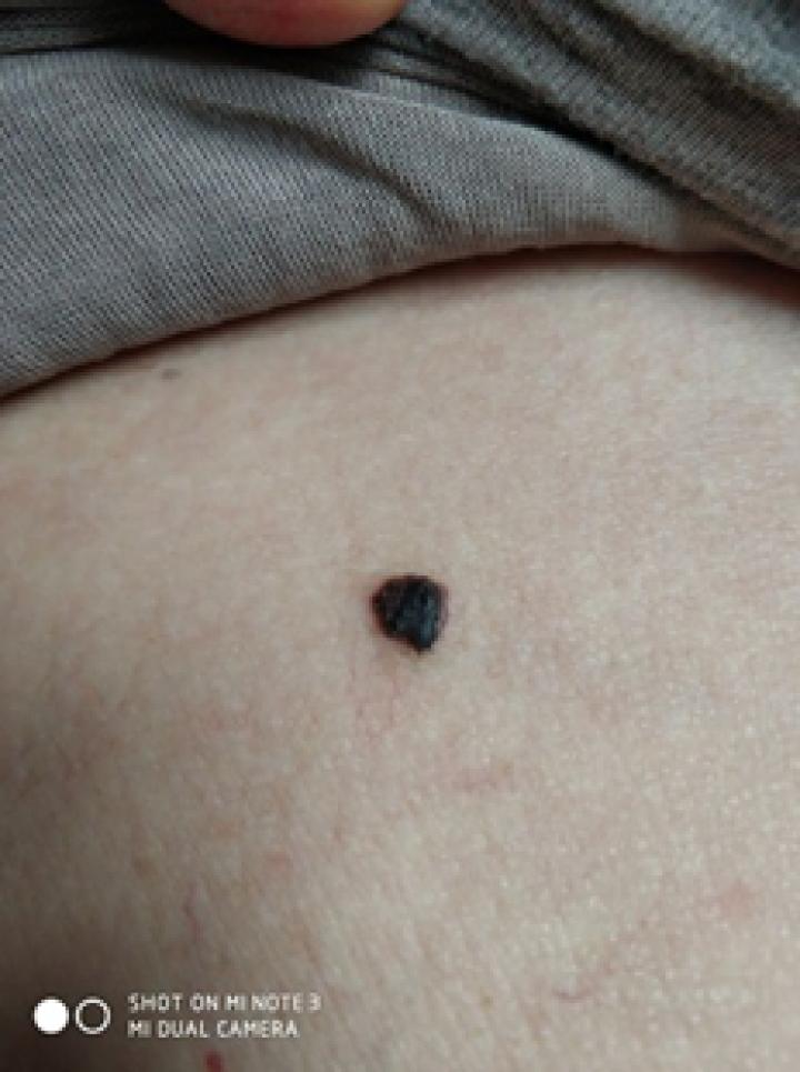 哪些部位长痣预示一生劳碌,痣的位置预示着什么