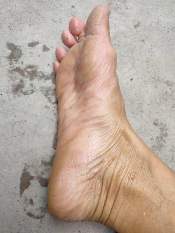 干燥敏感皮肤夏天怎么护理,夏天脸部皮肤脱皮干燥怎么办