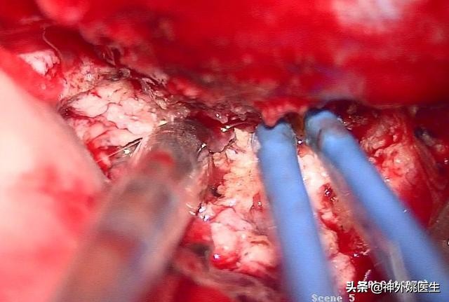 脑膜瘤是什么原因引起的啊,脑膜瘤手术治疗全部大概多少钱