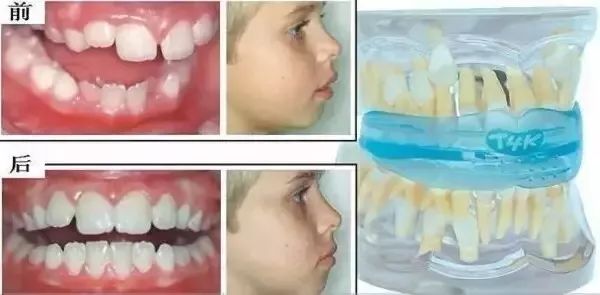 三岁孩子矫正牙齿后又反复,孩子牙齿矫正一个月看不到效果