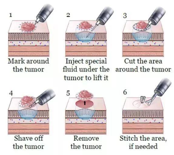 结肠镜检查送什么礼物,结肠镜老年人