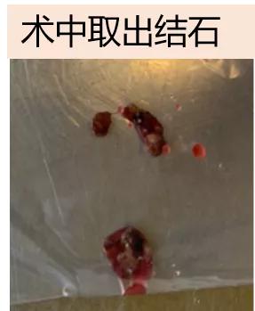 老年人肾结石感染最严重吗,肾结石微创真菌感染怎么办