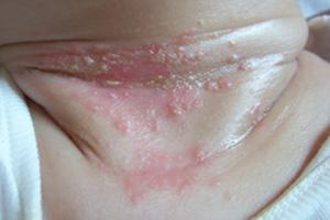 天气太热了宝宝长痱子怎么办,宝宝夏天痱子用什么方法消除最快