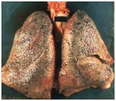 强生婴儿爽身粉事件召回,强生为什么要召回爽身粉