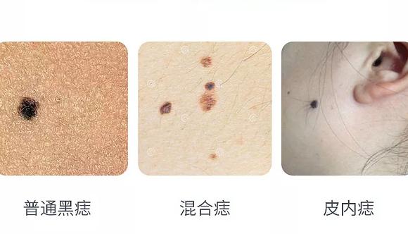 华亦俏朱红博士说:祛痣应该注意什么?