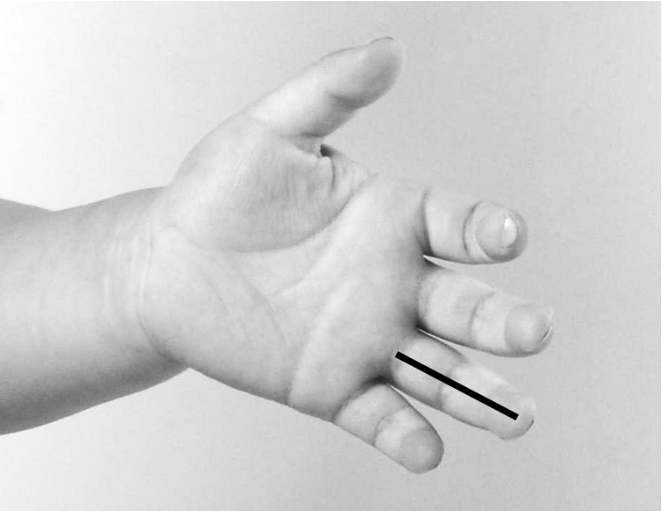 过敏性鼻炎推拿有效果吗,小宝宝过敏性鼻炎怎么推拿