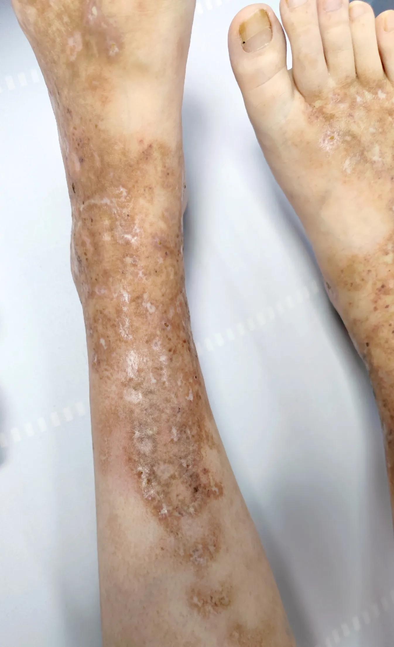 小腿上黑色疤痕怎么回事,小腿上的一个疤痕发黑