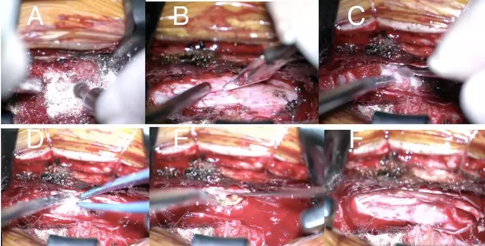 腰椎管内畸胎瘤能不能彻底治愈,腰椎管狭窄加脊柱侧弯怎么治疗