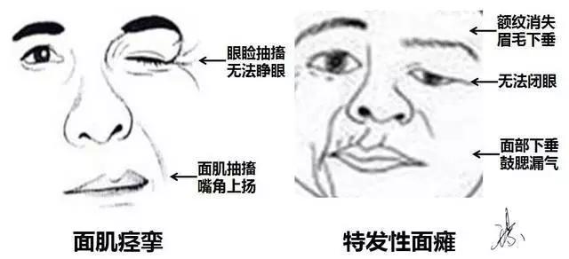 面肌痉挛右眼皮跳北京哪里治疗,眼皮一直抽搐跳动的原因面肌痉挛