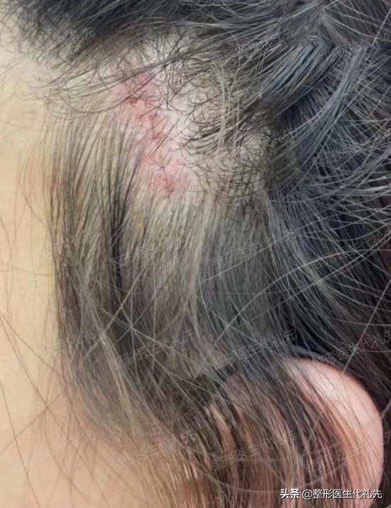 现在最流行的面部提升是什么项目,目前最先进效果最好的面部提升