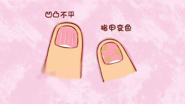 去除灰指甲的杀菌药,消灭灰指甲