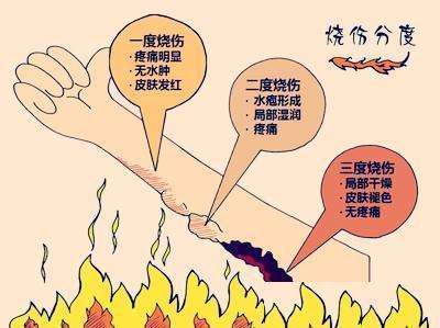 烧伤快好了痒发红发热是怎么回事,烧伤伤口痒