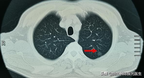 长期观察不变的肺结节是肺癌吗,肺结节观察几年基本就没有变化了