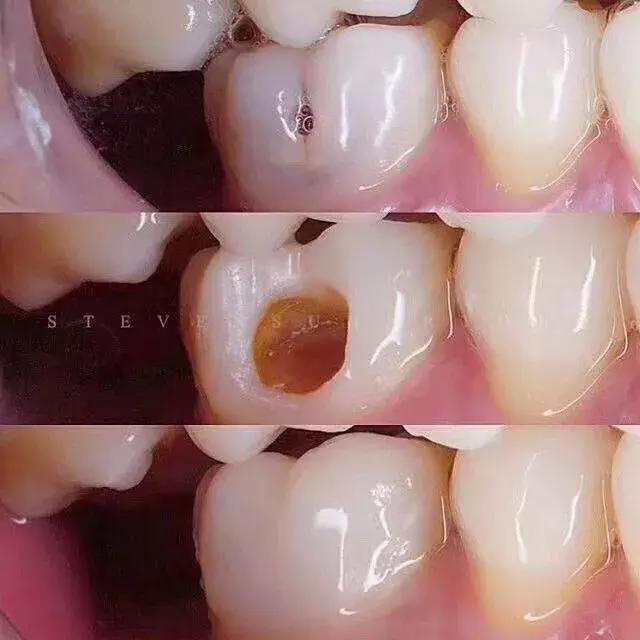 牙齿烂了一半为什么不能补牙,牙齿缺了一半补牙要多少钱