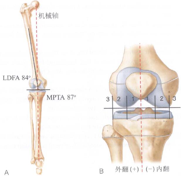 膝内翻与膝外翻的区别儿童,3岁小孩膝外翻常见吗需要治疗吗