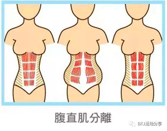 宝妈腹直肌分离肚皮松垮,产后妈妈腹直肌分离是怎么回事