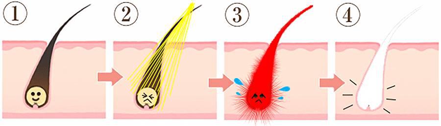 猕猴桃女孩怎样有效脱毛,猕猴桃女孩一定要脱毛吗