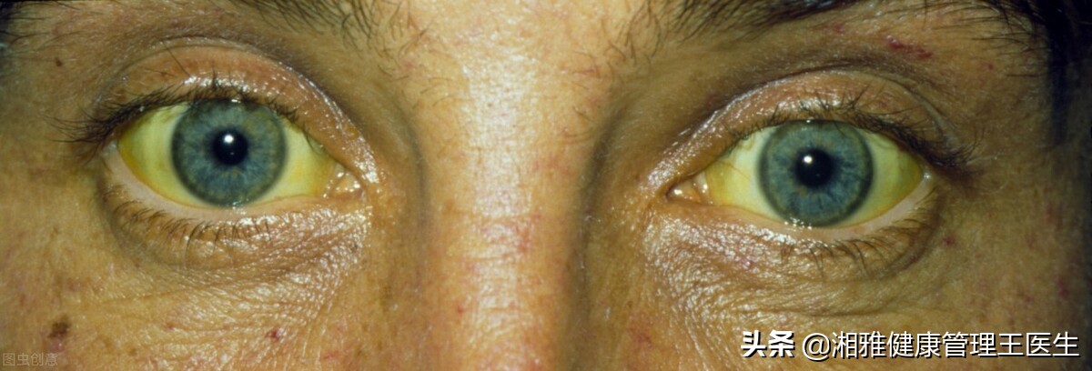 肝癌来临时会有这些表现，最好的措施就是这样治疗