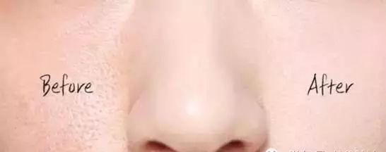 毛孔粗大皮肤暗黄该怎么改善肤质,毛孔粗大肤色暗沉应该怎么改善