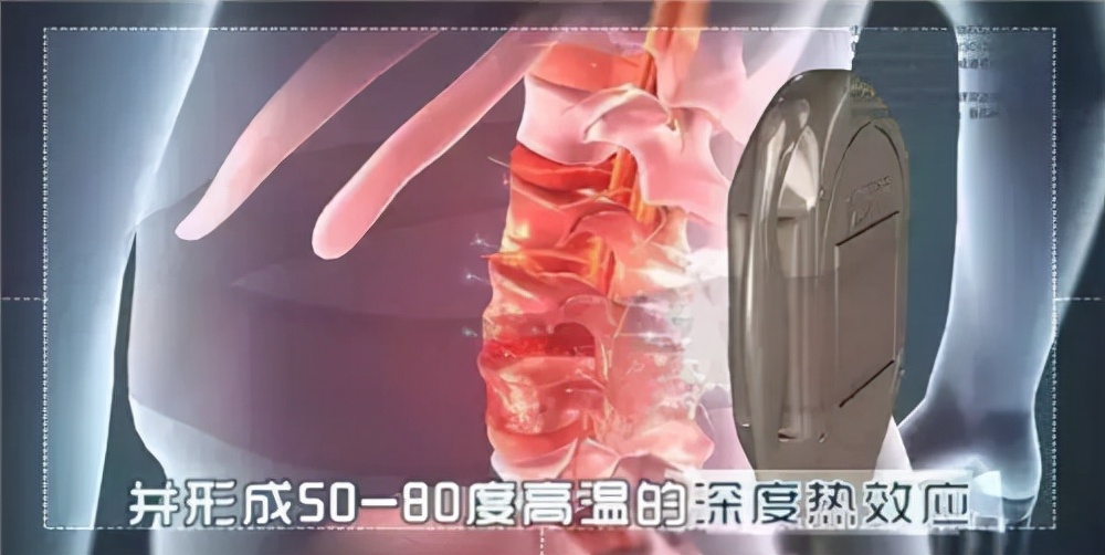 京东铁腰板真能治腰突吗,治疗腰突的铁腰板价格多少