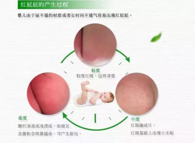 宝宝红屁屁看着心疼,宝宝红屁屁疼得厉害怎么办