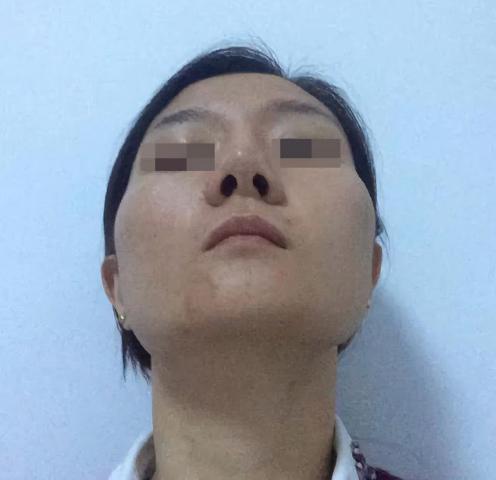 如何改善大小脸咬肌不对称原因,大小脸不对称自我矫正方法学生