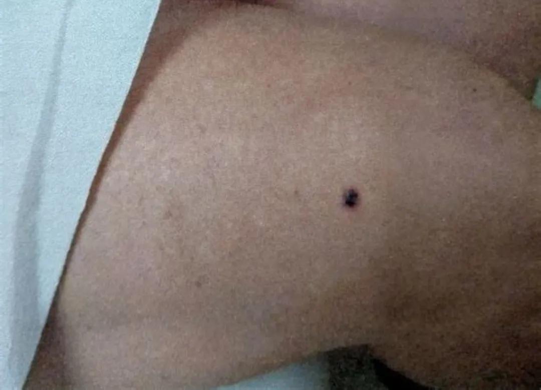 痣真的有那么大的癌变几率吗,痣会癌变真的很可怕吗