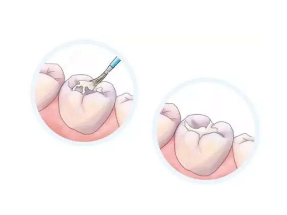 牙科医生检查小朋友口腔,口腔门诊免费窝沟封闭申请