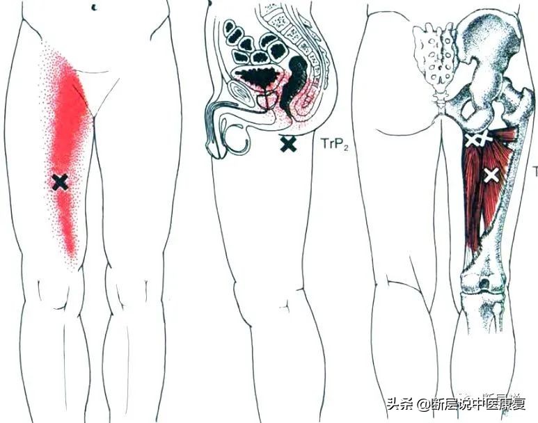 妇科盆腔疼痛症,盆腔筋膜炎如何彻底治愈