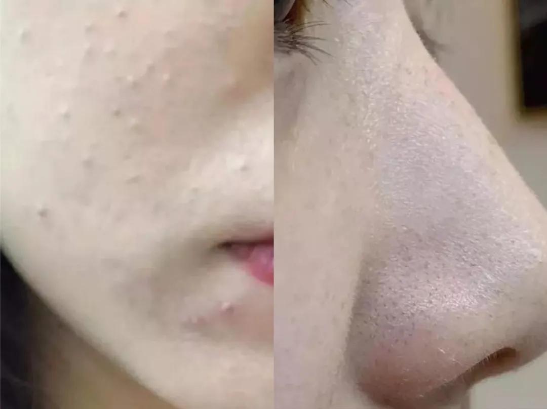 隐藏款改善黑头洗面奶,用完不长黑头和扩大毛孔的洗面奶