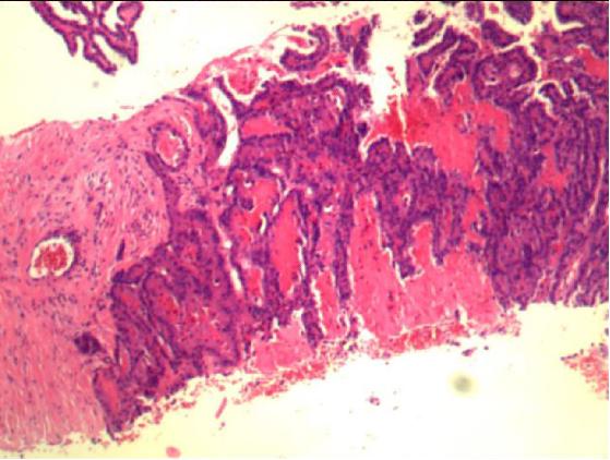 查出来“甲状腺癌”，还能活多久？最详细的治疗介绍如下