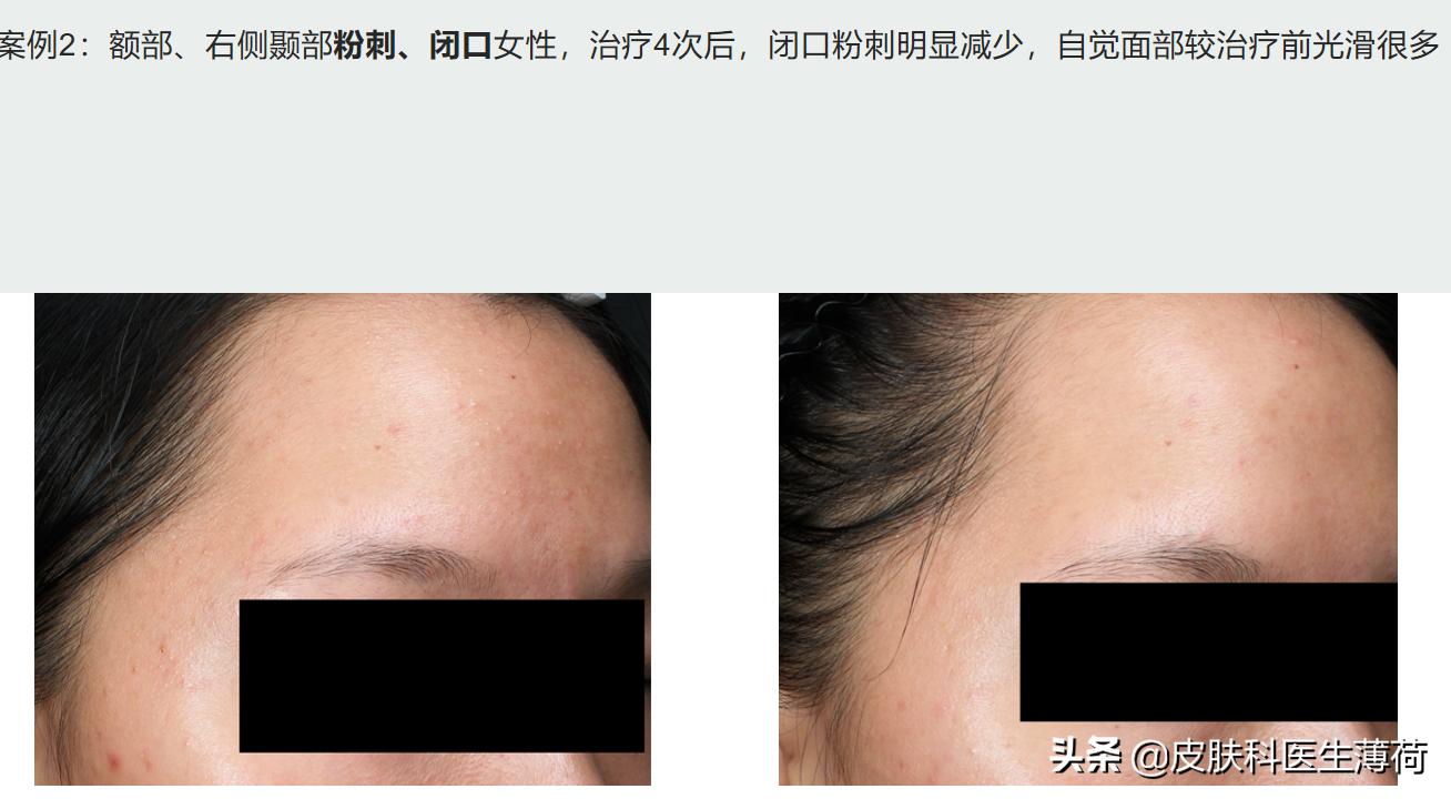 水杨酸精华果酸去闭口粉刺,刷酸去黑头收缩毛孔用哪个产品好