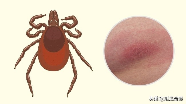 夏季蚊虫叮咬教你一招轻松解决,各种昆虫叮咬清晰图片对照表