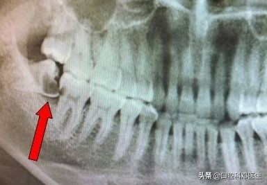 为什么智齿反复发炎牙龈肿痛,智齿发炎了引起口腔内壁发白疼痛