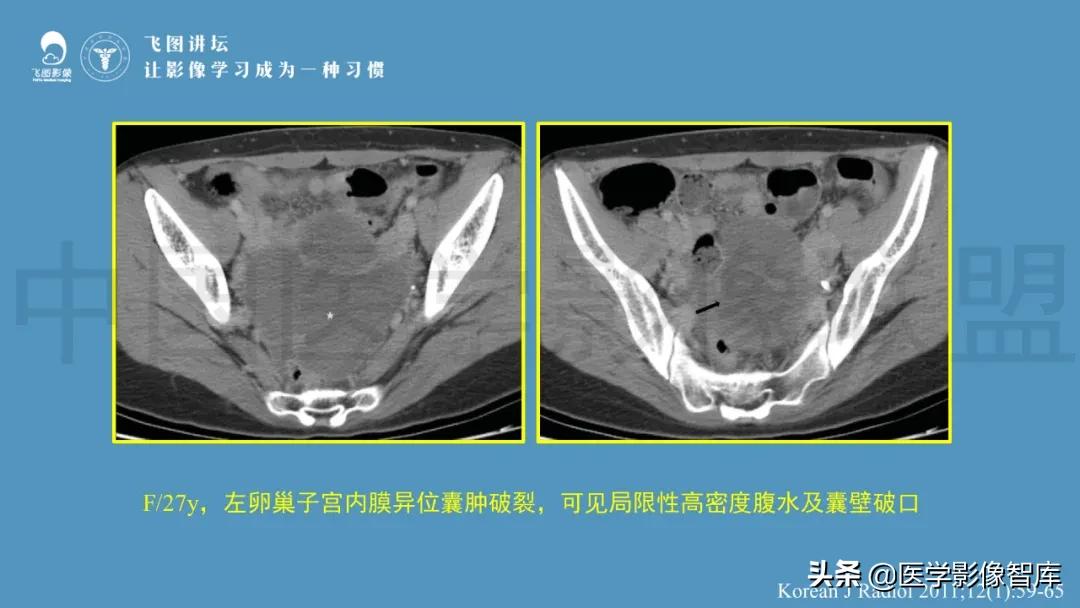 子宫解剖结构输卵管和卵巢位置,子宫附件ct影像学正常解剖表现