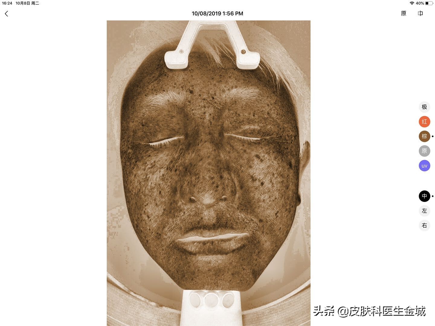 皮肤美容医生超皮秒全体验,皮肤美容医生超皮秒