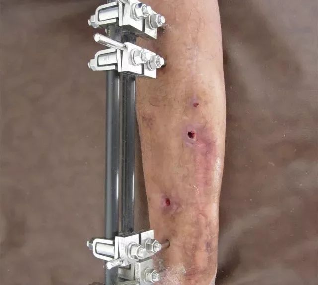 骨髓炎为什么越来越难治疗,如何才算治好慢性骨髓炎