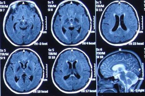 结核性脑积水,脑膜炎脑积水要治疗多久