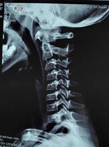 医生说“颈椎曲度变直或者反弓”该怎么办