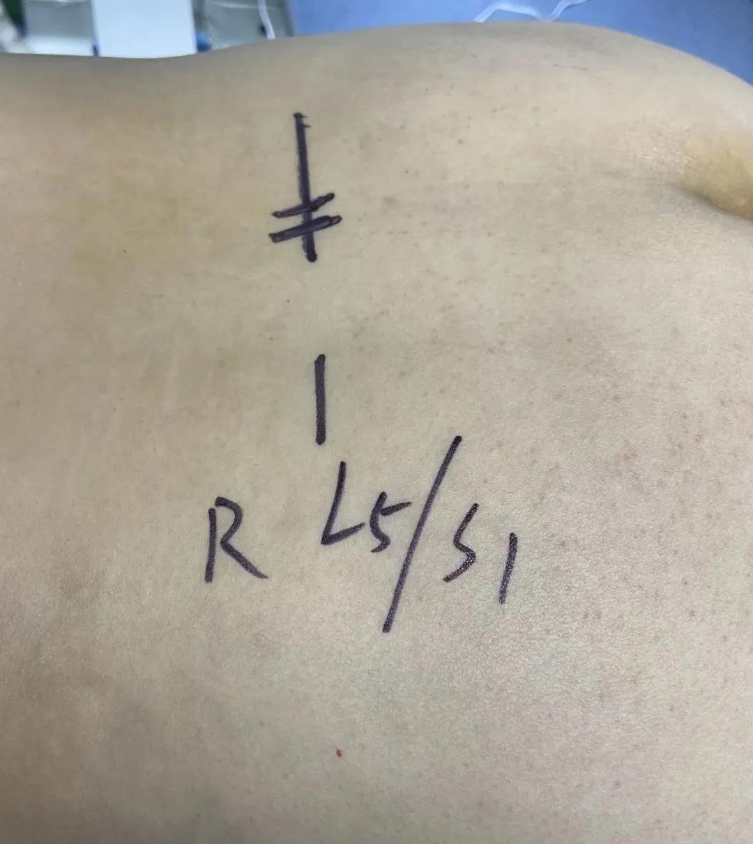 渭南治腰间盘突出哪家最好,脊柱神经外科手术