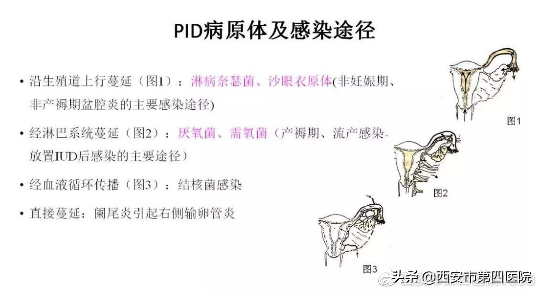 月经后盆腔炎严重怎么回事,盆腔炎是怎么回事儿