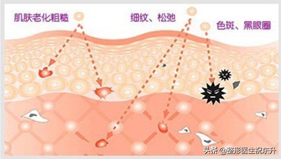 做光子嫩肤前后应注意事项,关于做光子嫩肤的分享