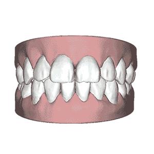 牙齿松动牙缝变宽最佳补救方法,牙齿松动牙缝越来越大是什么原因