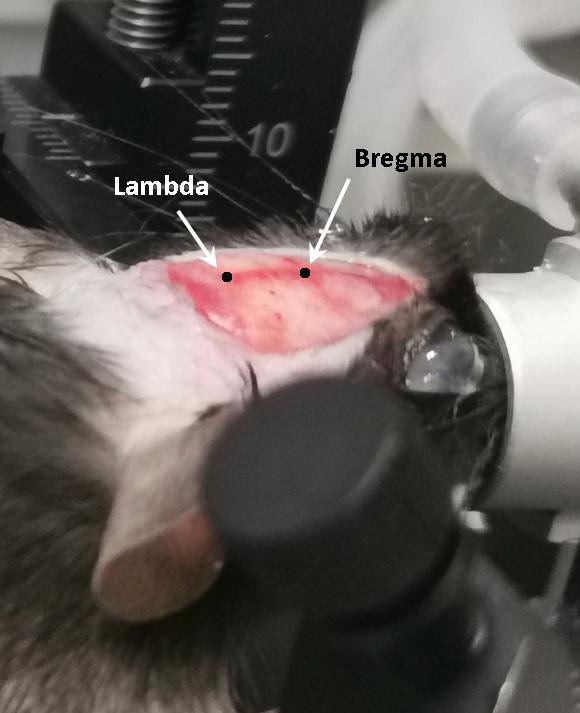 晶体植入手术的分享,可调微丝阵列电极