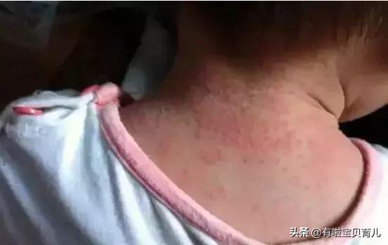 麻疹样幼儿急疹,麻疹风疹幼儿急疹的鉴别点有哪些