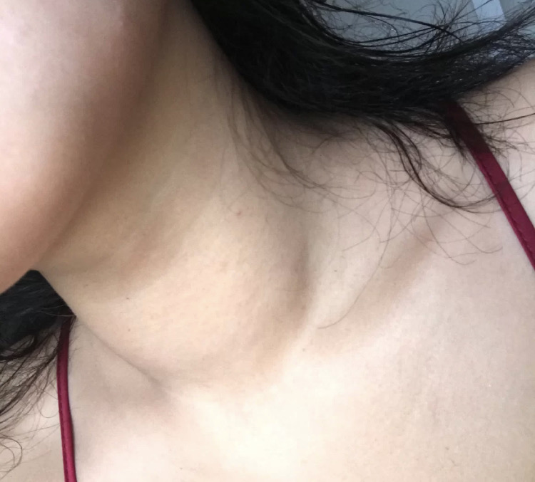 甲功五项查出甲减严不严重,甲减停药2年甲功正常