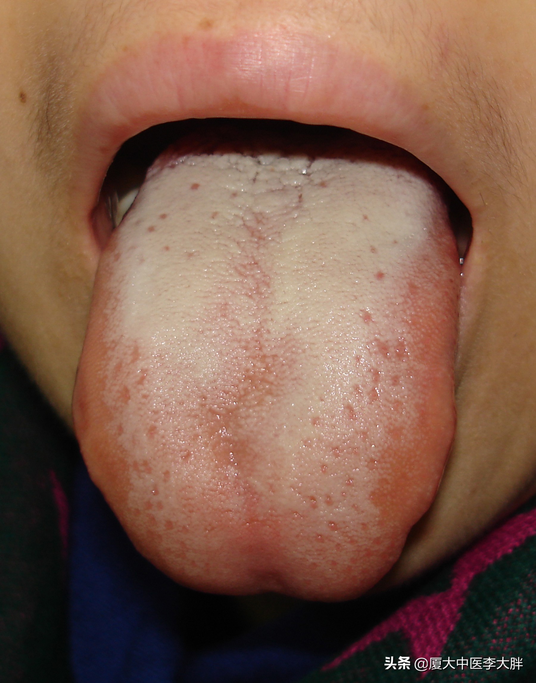 幽门螺旋杆菌哪些必须治疗,什么食疗方法治疗幽门螺旋杆菌