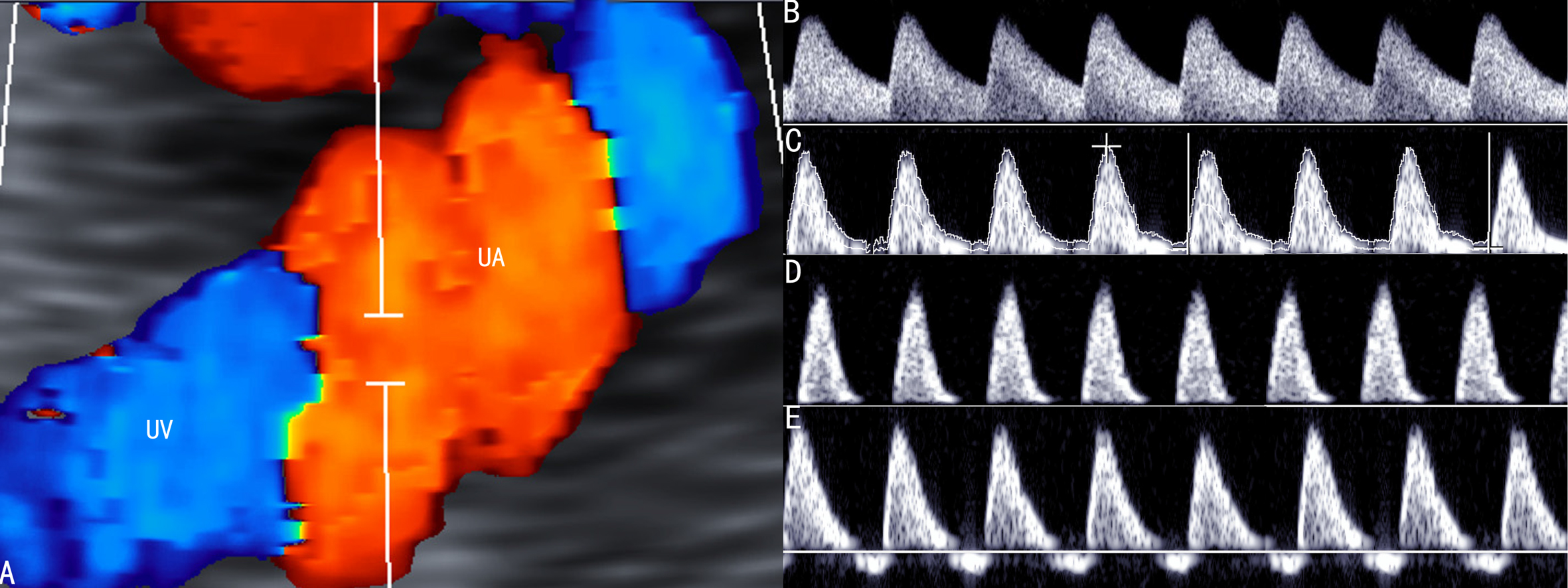 胎儿2级彩色多普勒超声图片,彩色多普勒胎儿超声诊断报告单