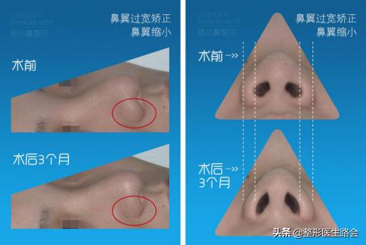 鼻翼缩小外切好吗,鼻翼缩小外切还是内切效果好