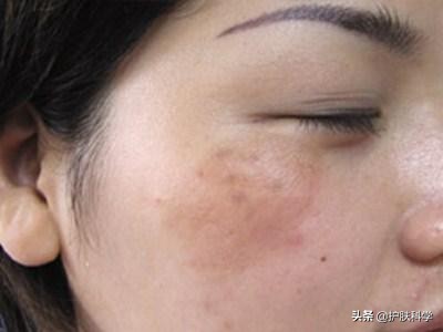 脸上长斑怎么办教你一个小妙招,脸上有斑怎么消除黑斑